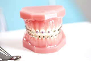 Braces for teeth