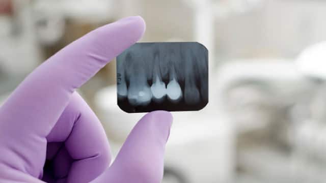 Radiografía de dientes