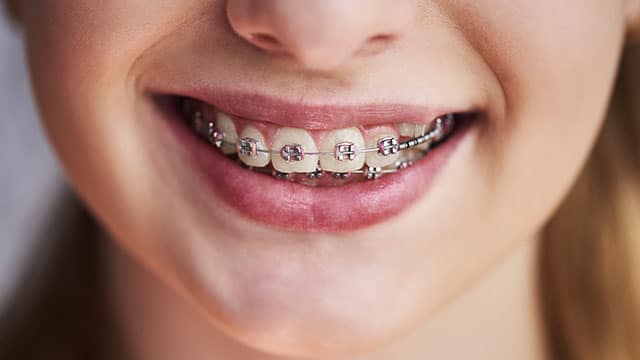 Close up of teeth with braces
