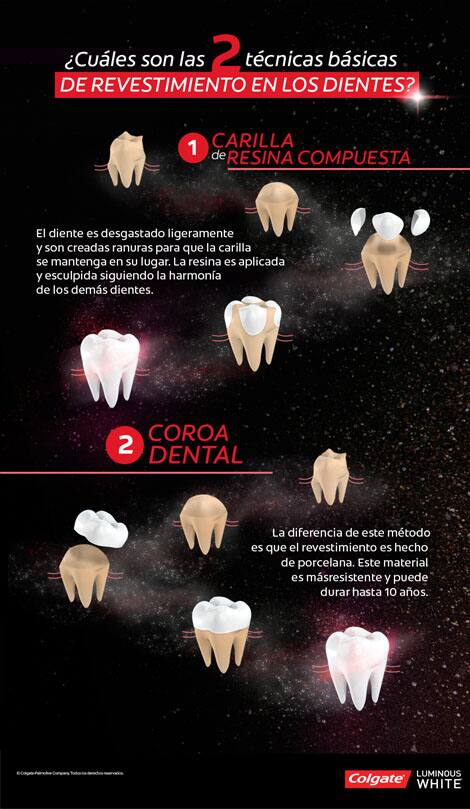 Infografía sobre las 2 técnicas de revestimiento en los dientes
