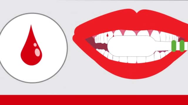 Gingivitis: Signos Y Síntomas