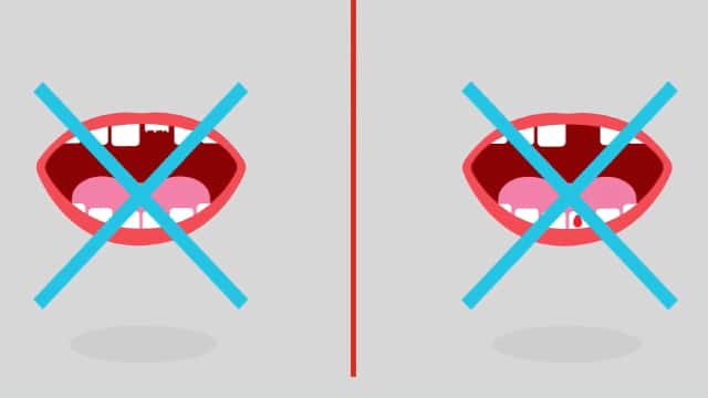 Dientes de leche flojos