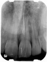 Periapical