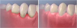 Gingival Flap Surgery