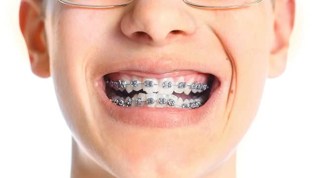 Caring For Braces