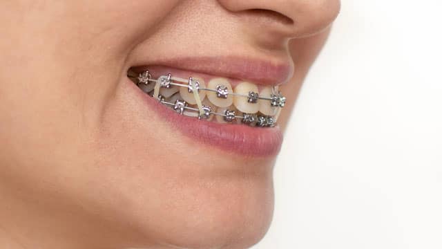 What Your Braces Rubber Band Color Says About You - Orthodontist