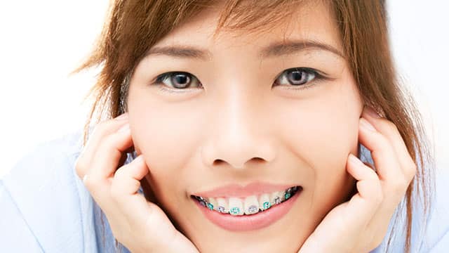 Clear Braces for Adults - Your Ultimate Guide