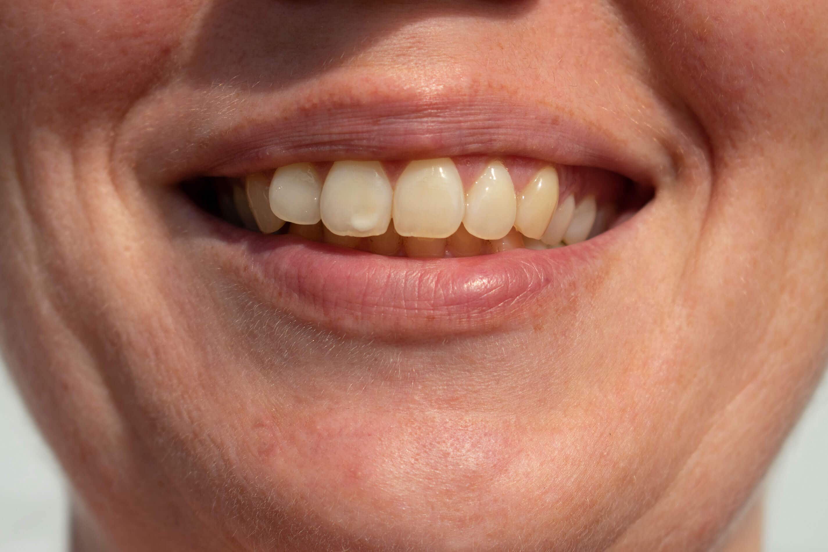 How To Get Rid of White Spots on Teeth
