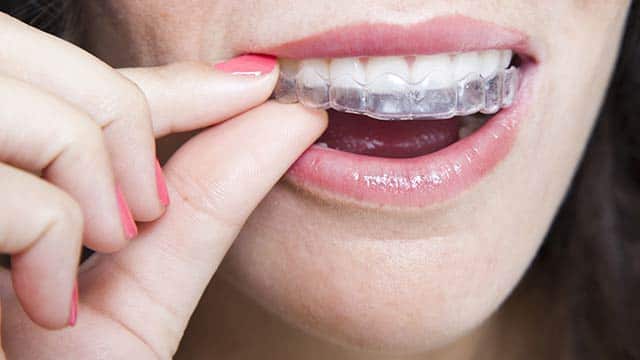 What Do Invisalign Braces Cost? Are They Worth It?